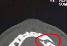 Komoly műtéttel rakták helyre Jake Paul két helyen eltört állkapcsát – videó